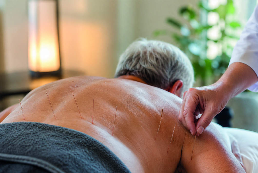 La acupuntura demuestra beneficios para aliviar el dolor lumbar crónico en adultos mayores