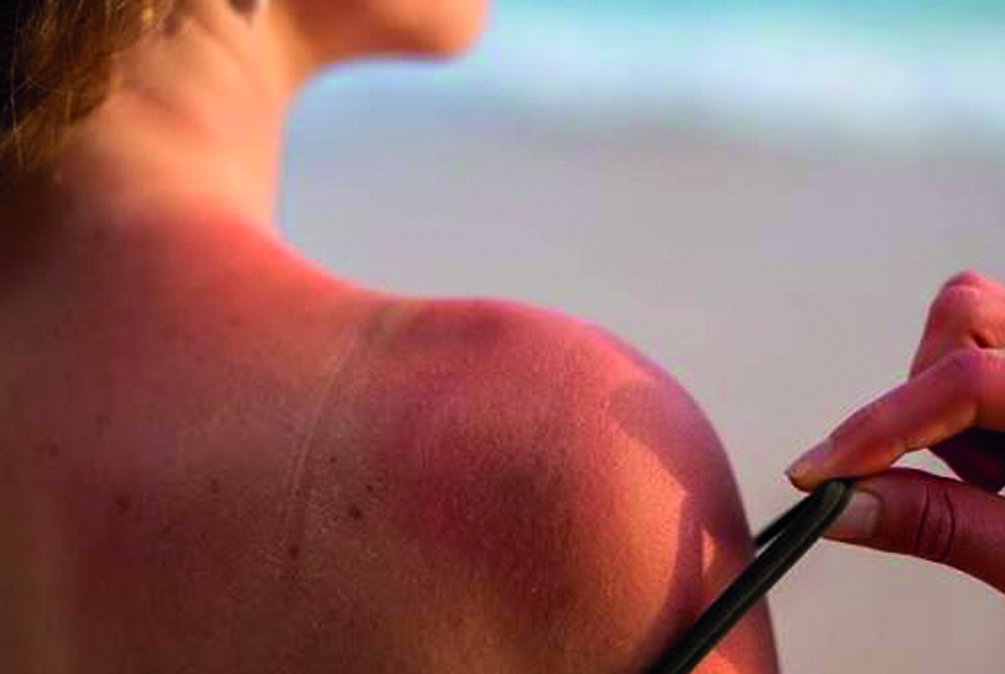 Piel dañada por el sol: tratamientos eficaces para combatir manchas, arrugas y fotoenvejecimiento